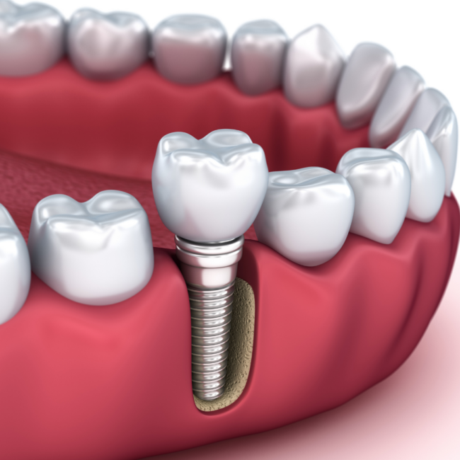 https://boadilladental.com/wp-content/uploads/2022/11/Implantes-en-odontologia-1.png