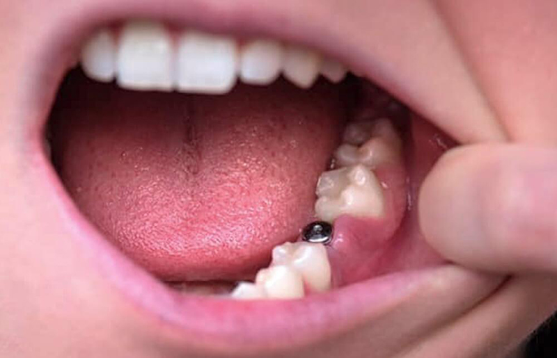 https://boadilladental.com/wp-content/uploads/2023/01/Que-es-un-implante-dental.jpg
