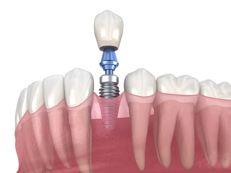 https://boadilladental.com/wp-content/uploads/2023/01/implantes-dentales-en-Boadilla.jpg