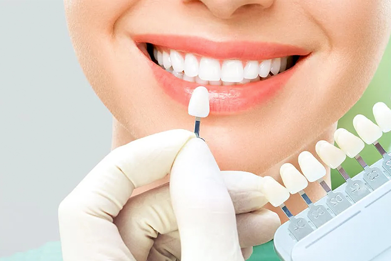 Las carillas dentales como solución estética; Todos los detalles