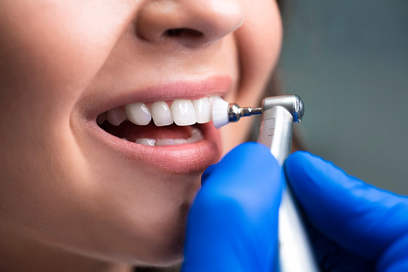 5 Razones por las que hacerte una limpieza dental regularmente