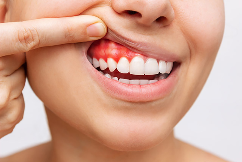 Qué es la periodontitis y cómo se previene