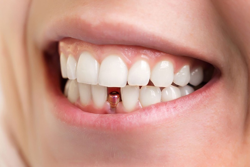 10 preguntas frecuentes sobre implantes dentales