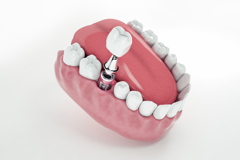 Los beneficios de los implantes dentales: una solución duradera y natural