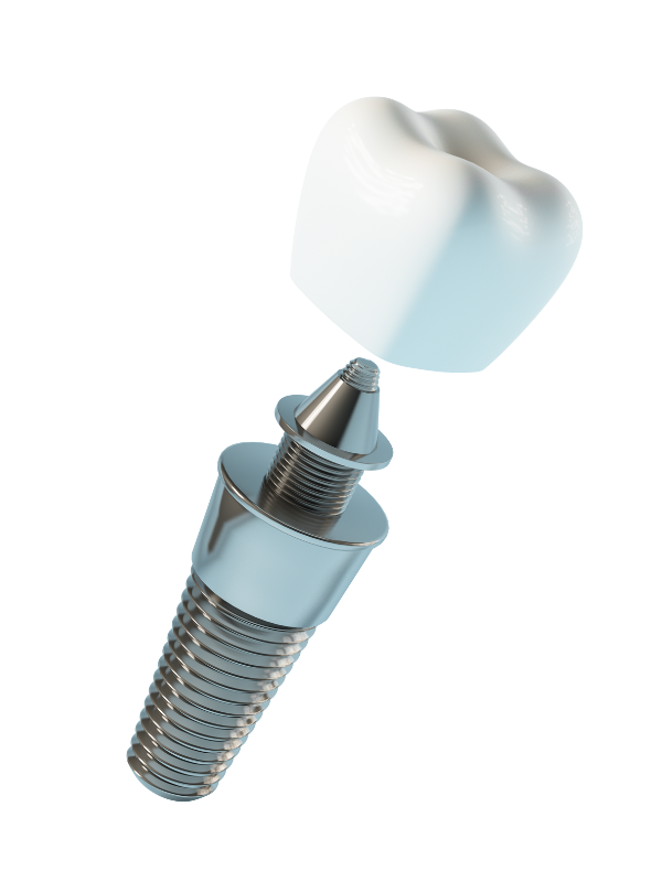 Implante Dental Precio en Boadilla