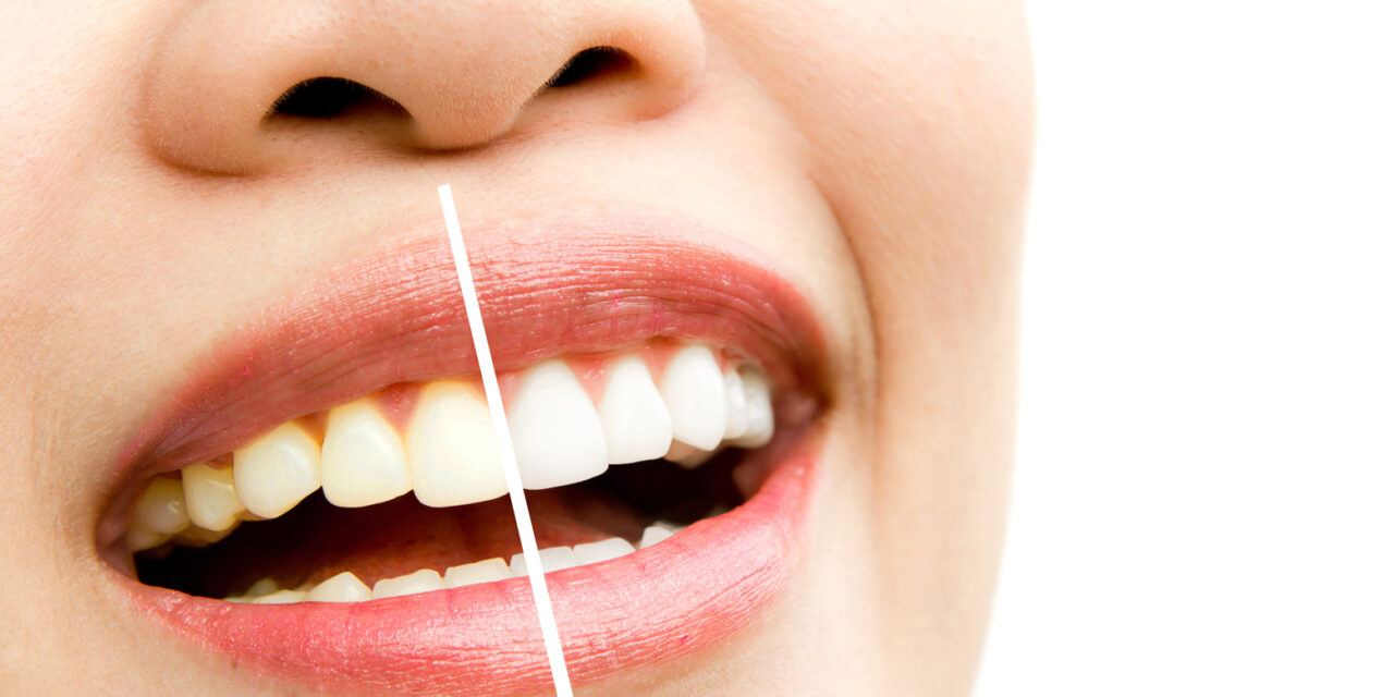 Mitos y realidades sobre los blanqueamientos dentales: lo que debes saber