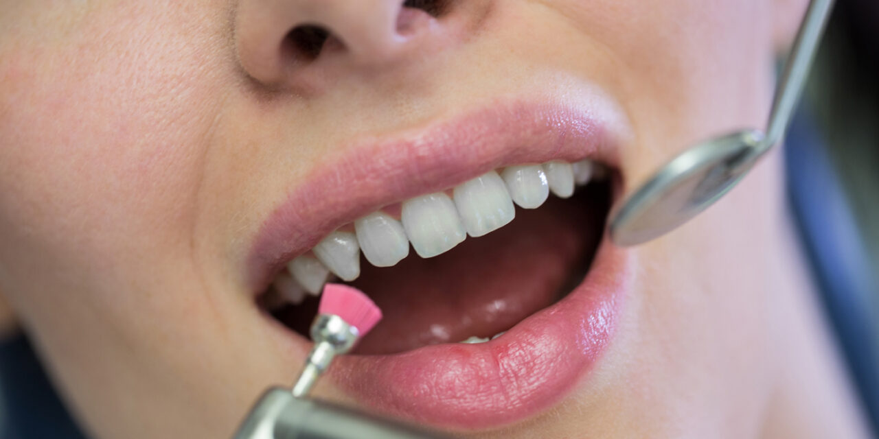 ¿Qué es la profilaxis dental y por qué deberías hacértela al menos una vez al año?