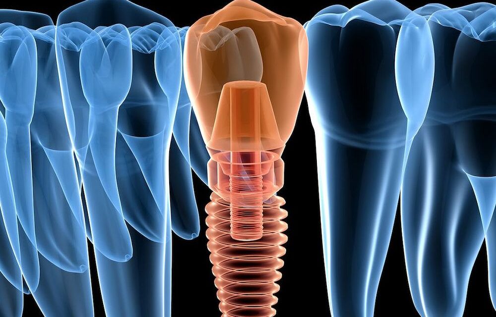 Especialistas en Implantes Dentales en Boadilla del Monte