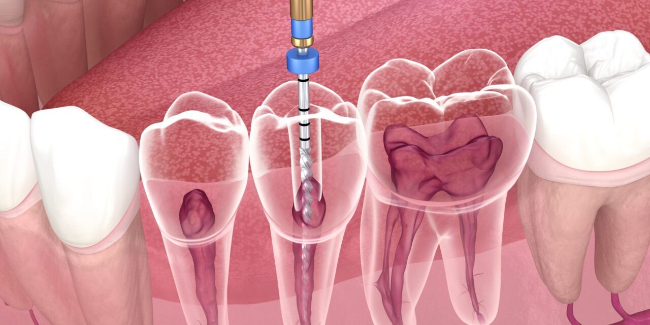 Endodoncia: ¿qué es y en qué consiste?