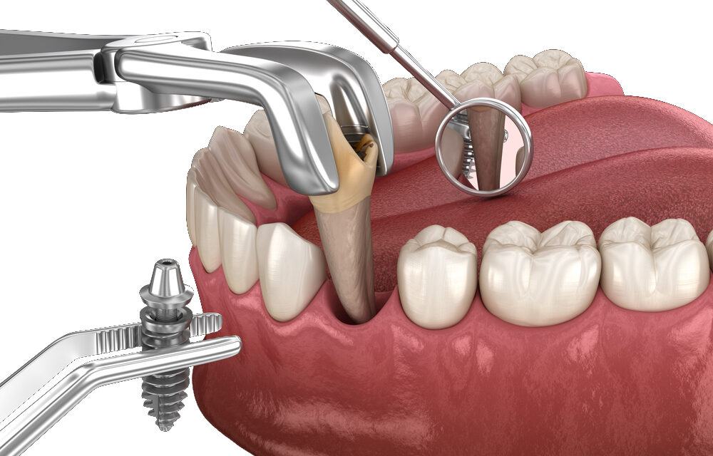 Carga inmediata en implantes dentales en Boadilla del Monte