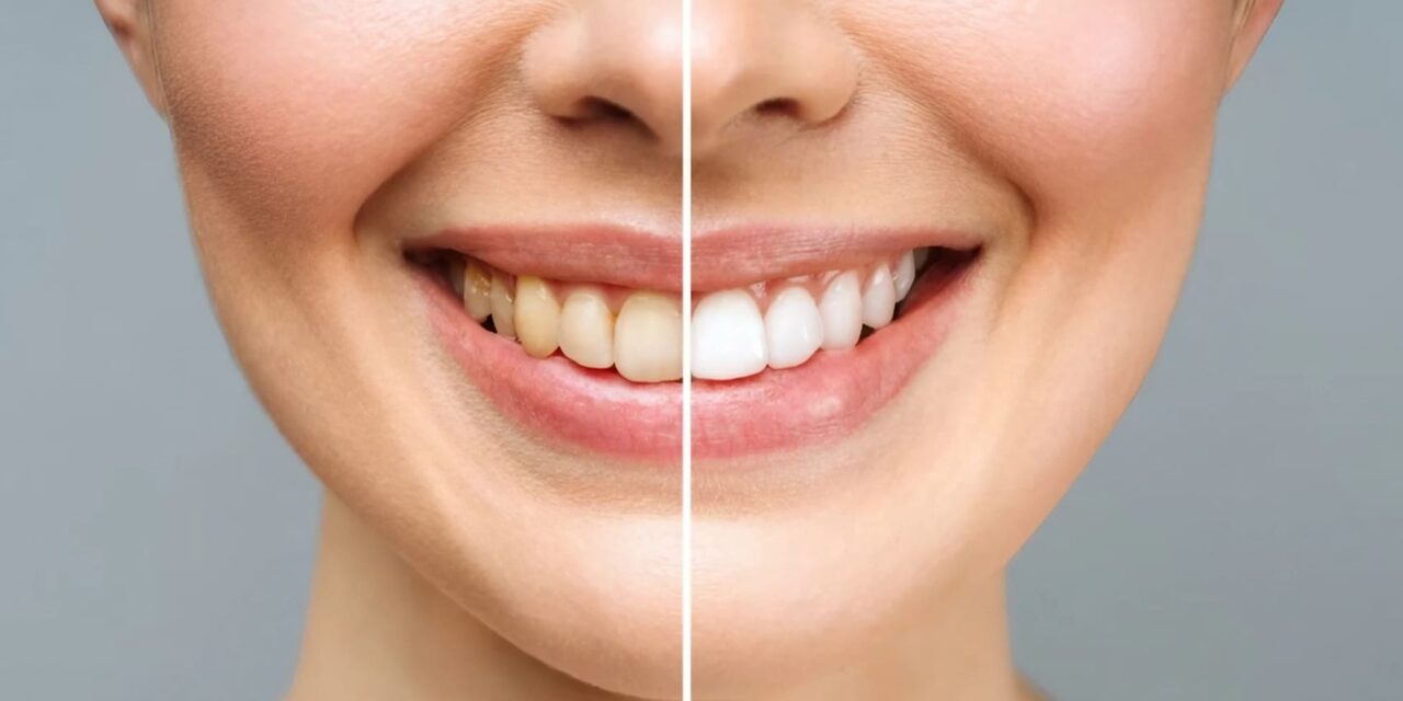 Blanqueamiento dental premium en Boadilla del Monte
