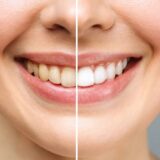 Blanqueamiento dental premium en Boadilla del Monte