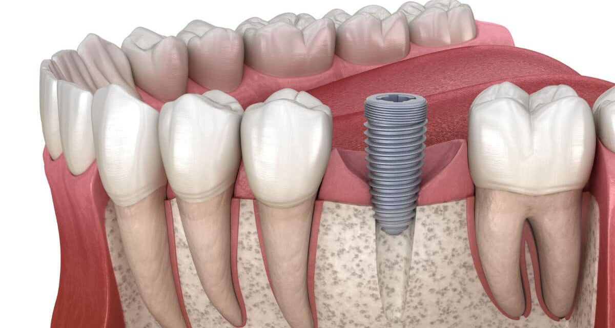 ¿Qué es la osteointegración en los implantes dentales?